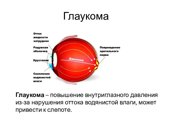 Глаукома Глаукома – повышение внутриглазного давления из-за нарушения оттока водянистой влаги, может привести к слепоте.