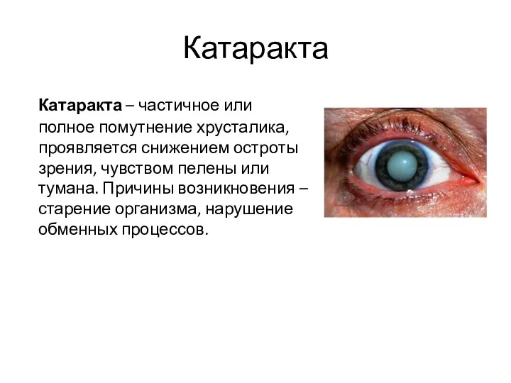 Катаракта Катаракта – частичное или полное помутнение хрусталика, проявляется снижением остроты зрения,
