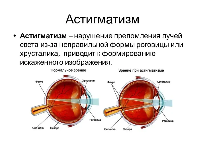 Астигматизм Астигматизм – нарушение преломления лучей света из-за неправильной формы роговицы или