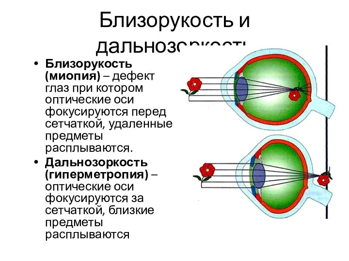 Близорукость и дальнозоркость Близорукость (миопия) – дефект глаз при котором оптические оси