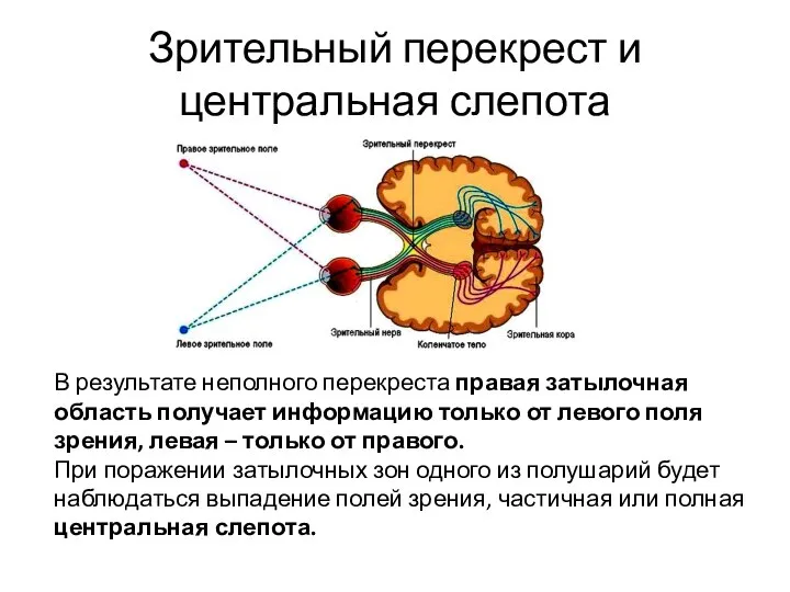 Зрительный перекрест и центральная слепота В результате неполного перекреста правая затылочная область