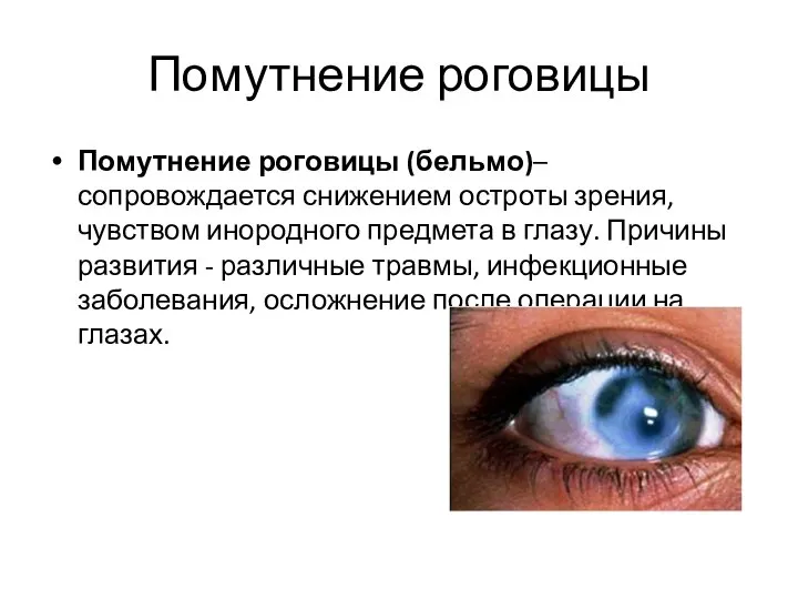 Помутнение роговицы Помутнение роговицы (бельмо)– сопровождается снижением остроты зрения, чувством инородного предмета