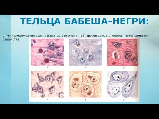 ТЕЛЬЦА БАБЕША-НЕГРИ: цитоплазматические эозинофильные включения, обнаруживаемые в клетках гиппокампа при бешенстве.