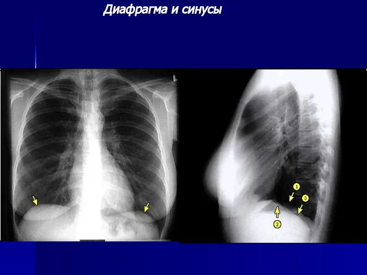 Диафрагма и синусы