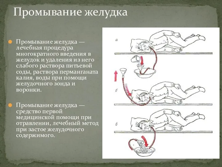 Промывание желудка — лечебная процедура многократного введения в желудок и удаления из