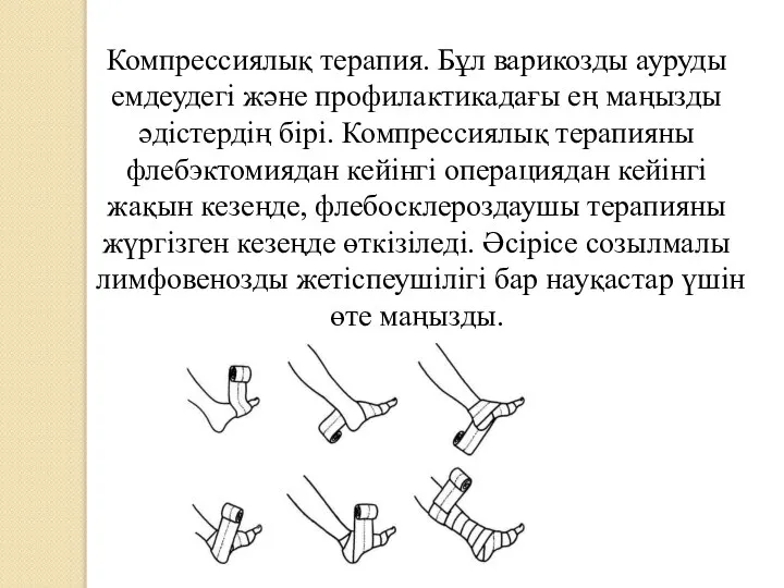 Компрессиялық терапия. Бұл варикозды ауруды емдеудегі және профилактикадағы ең маңызды әдістердің бірі.