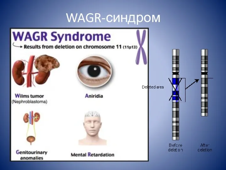 WAGR-синдром
