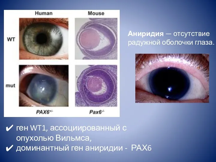 Аниридия — отсутствие радужной оболочки глаза. ген WT1, ассоциированный с опухолью Вильмса,