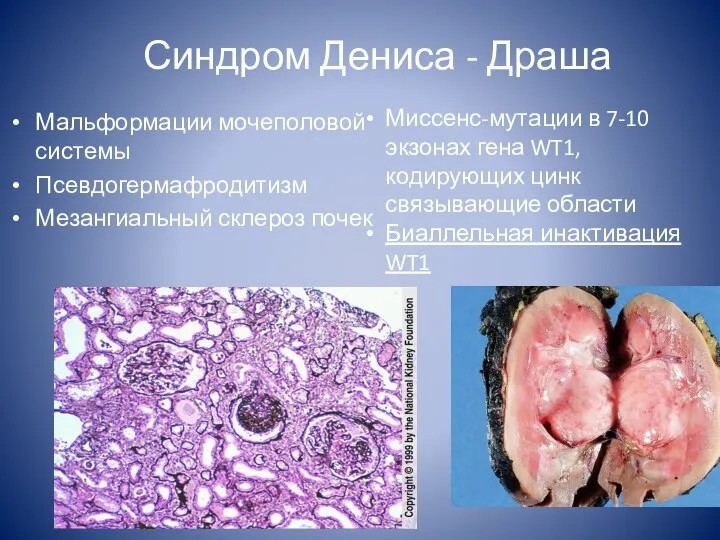 Синдром Дениса - Драша Мальформации мочеполовой системы Псевдогермафродитизм Мезангиальный склероз почек Миссенс-мутации