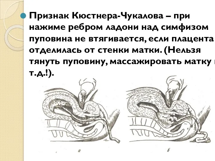 Признак Кюстнера-Чукалова – при нажиме ребром ладони над симфизом пуповина не втягивается,