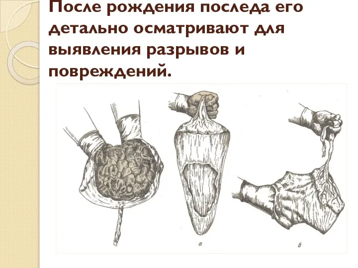 После рождения последа его детально осматривают для выявления разрывов и повреждений.