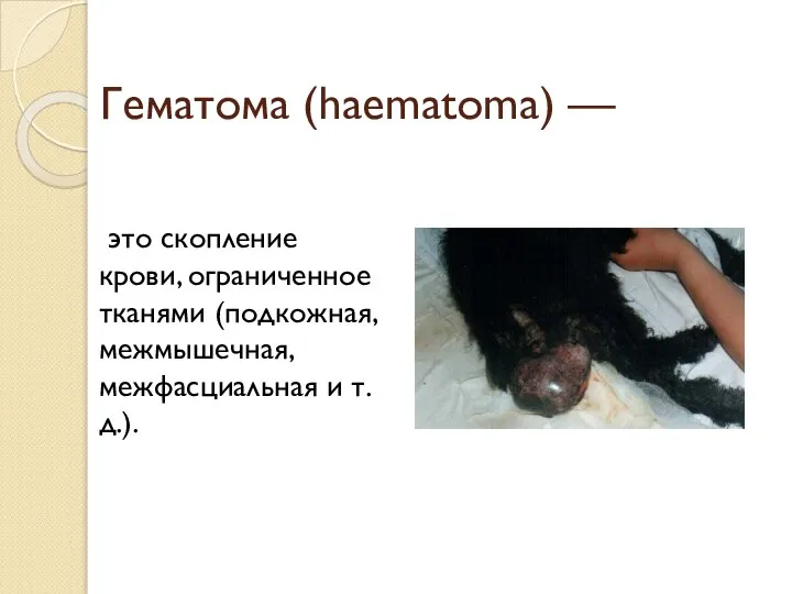 Гематома (haematoma) — это скопление крови, ограниченное тканями (подкожная, межмышечная, межфасциальная и т. д.).