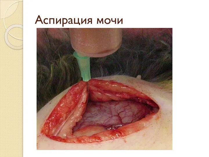 Аспирация мочи