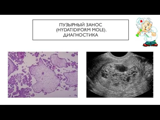 ПУЗЫРНЫЙ ЗАНОС (HYDATIDIFORM MOLE). ДИАГНОСТИКА