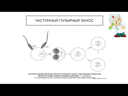 ЧАСТИЧНЫЙ ПУЗЫРНЫЙ ЗАНОС