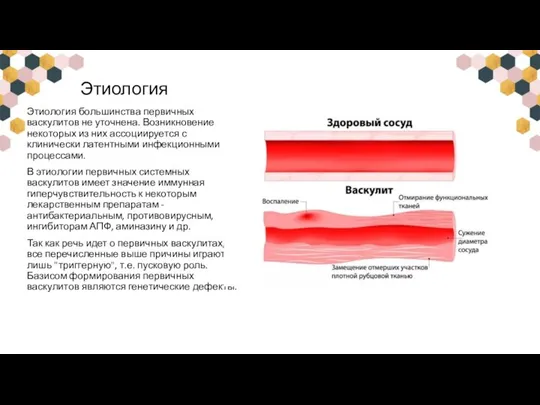 Этиология Этиология большинства первичных васкулитов не уточнена. Возникновение некоторых из них ассоциируется