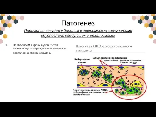 Патогенез Появлением в крови аутоантител, вызывающих повреждение и иммунное воспаление стенки сосудов.