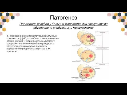 Патогенез 2. Образованием циркулирующих иммунных комплексов (ЦИК), способных фиксироваться в стенке сосудов