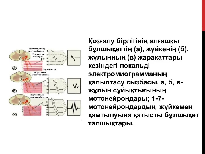 Қозғалу бірлігінің алғашқы бұлшықеттің (а), жүйкенің (б), жұлынның (в) жарақаттары кезіндегі локальді