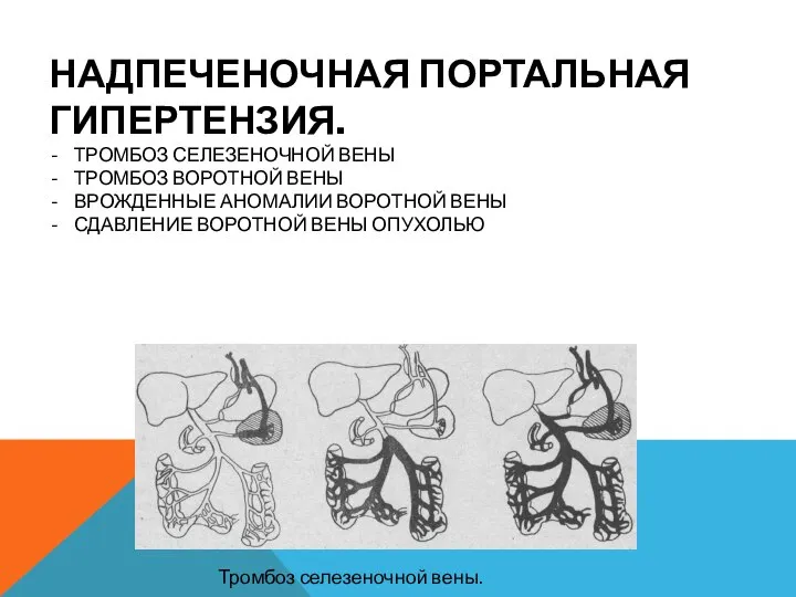 НАДПЕЧЕНОЧНАЯ ПОРТАЛЬНАЯ ГИПЕРТЕНЗИЯ. ТРОМБОЗ СЕЛЕЗЕНОЧНОЙ ВЕНЫ ТРОМБОЗ ВОРОТНОЙ ВЕНЫ ВРОЖДЕННЫЕ АНОМАЛИИ ВОРОТНОЙ