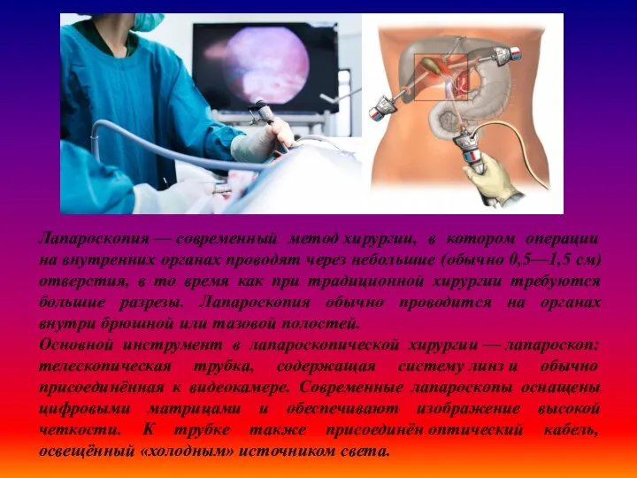 Лапароскопия — современный метод хирургии, в котором операции на внутренних органах проводят