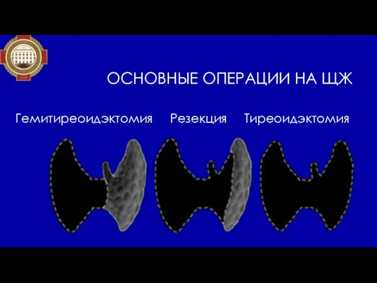 ОСНОВНЫЕ ОПЕРАЦИИ НА ЩЖ Гемитиреоидэктомия Резекция Тиреоидэктомия