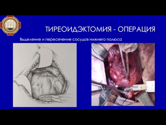 ТИРЕОИДЭКТОМИЯ - ОПЕРАЦИЯ Выделение и пересечение сосудов нижнего полюса