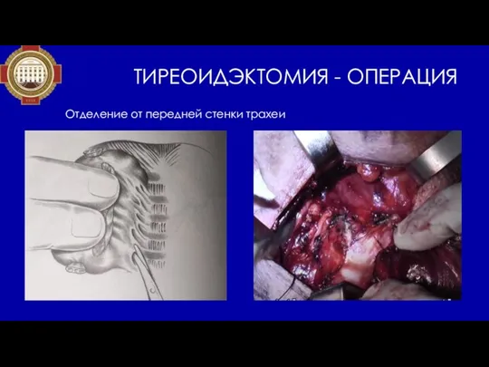 ТИРЕОИДЭКТОМИЯ - ОПЕРАЦИЯ Отделение от передней стенки трахеи