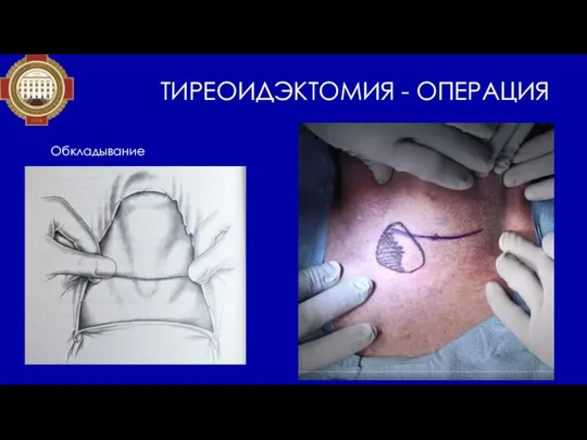 ТИРЕОИДЭКТОМИЯ - ОПЕРАЦИЯ Обкладывание