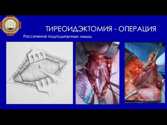 ТИРЕОИДЭКТОМИЯ - ОПЕРАЦИЯ Рассечение подподъязычных мышц