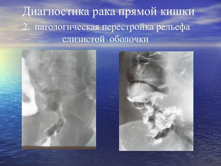 Диагностика рака прямой кишки 2. патологическая перестройка рельефа слизистой оболочки