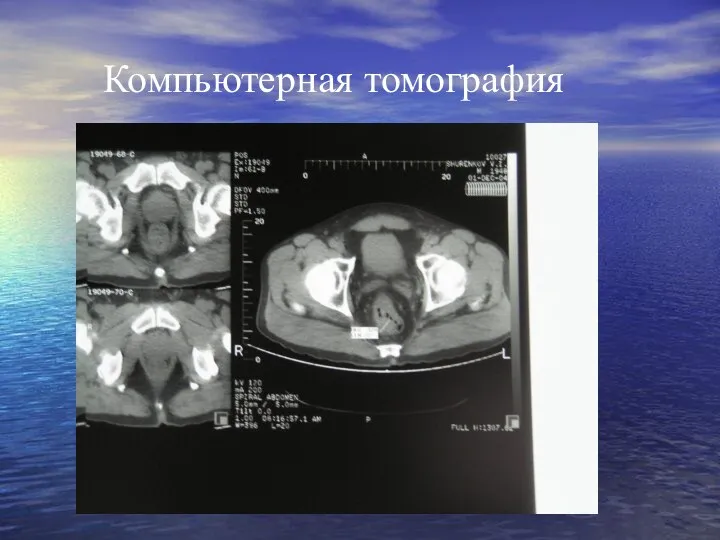 Компьютерная томография