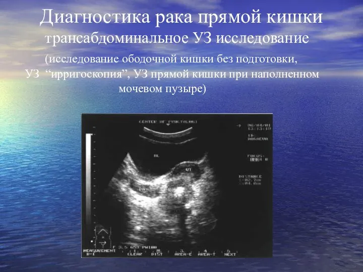 Диагностика рака прямой кишки трансабдоминальное УЗ исследование (исследование ободочной кишки без подготовки,