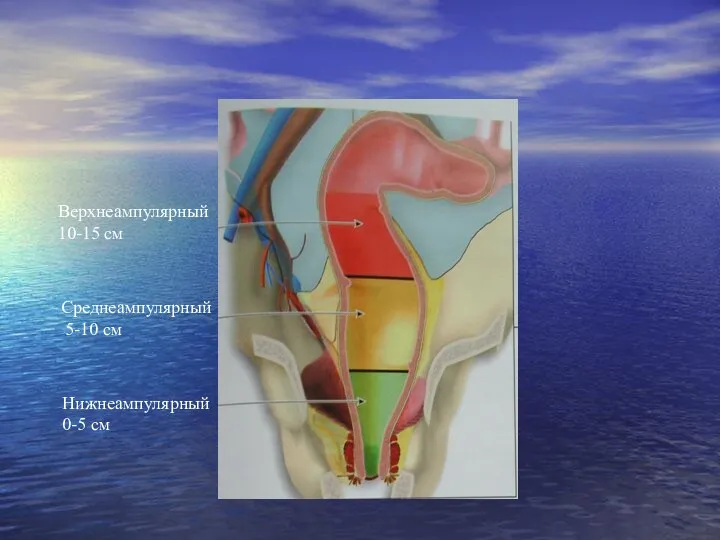 Верхнеампулярный 10-15 см Среднеампулярный 5-10 см Нижнеампулярный 0-5 см