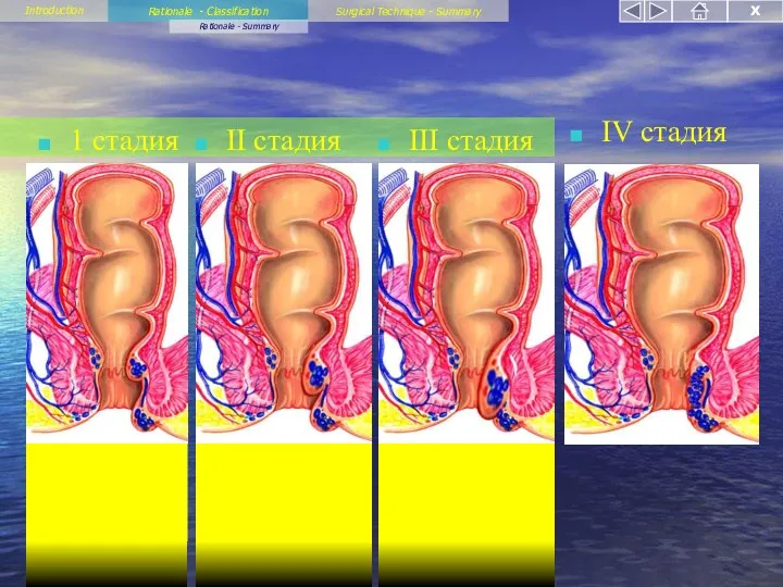 Rationale - Classification Rationale - Summary Introduction Surgical Technique - Summary X