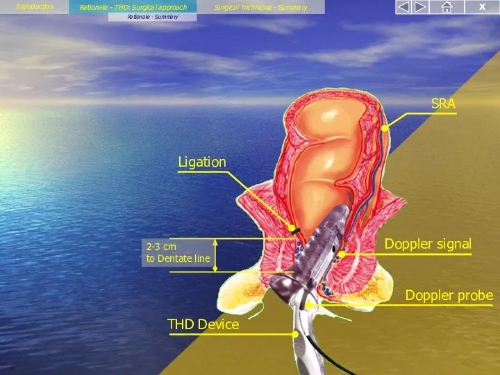 Rationale - THD: Surgical approach Rationale - Summary Introduction Surgical Technique - Summary X