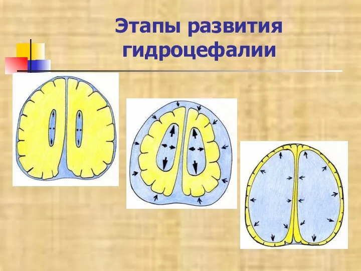 Этапы развития гидроцефалии