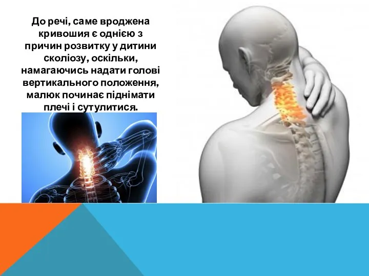 До речі, саме вроджена кривошия є однією з причин розвитку у дитини