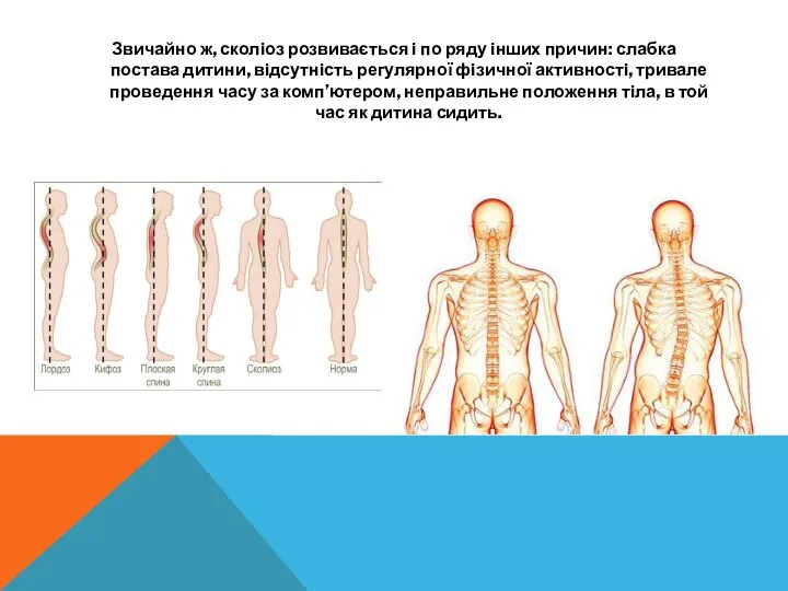 Звичайно ж, сколіоз розвивається і по ряду інших причин: слабка постава дитини,