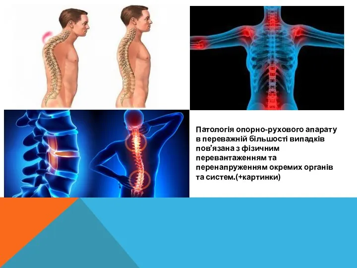 Патологія опорно-рухового апарату в переважній більшості випадків пов’язана з фізичним перевантаженням та