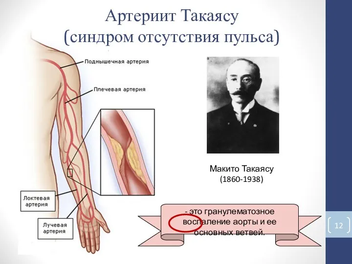 Артериит Такаясу (синдром отсутствия пульса) Макито Такаясу (1860-1938) - это гранулематозное воспаление