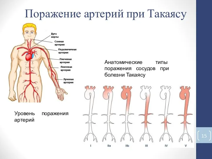 Уровень поражения артерий Анатомические типы поражения сосудов при болезни Такаясу Поражение артерий при Такаясу