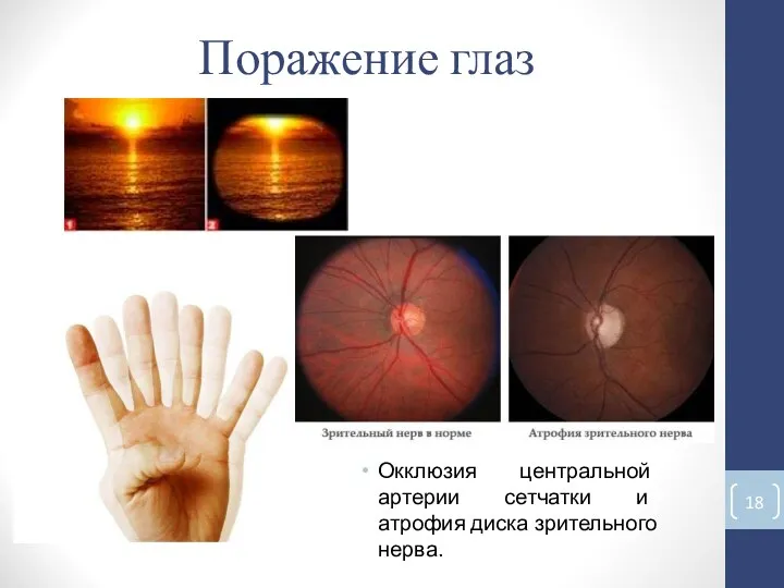 Поражение глаз Окклюзия центральной артерии сетчатки и атрофия диска зрительного нерва.