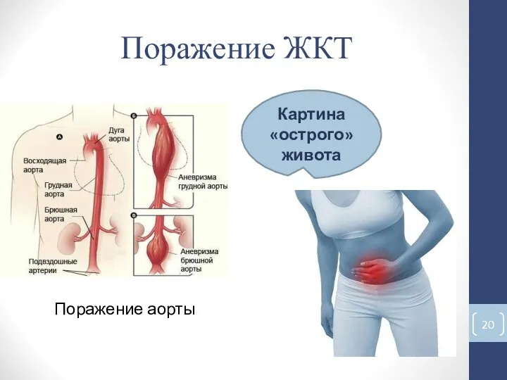 Поражение ЖКТ Поражение аорты Картина «острого» живота