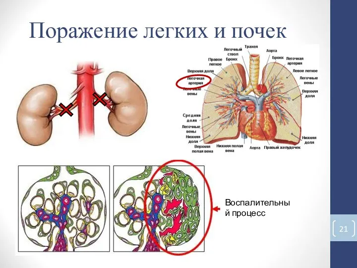 Поражение легких и почек Воспалительный процесс