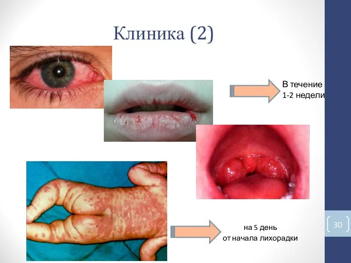 на 5 день от начала лихорадки Клиника (2) В течение 1-2 недели