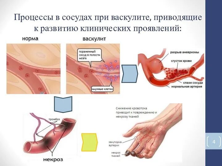 Процессы в сосудах при васкулите, приводящие к развитию клинических проявлений: