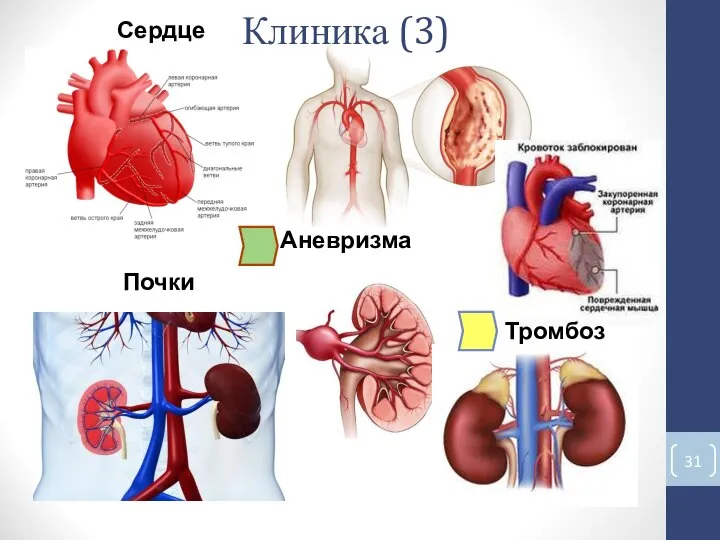 Почки Сердце Аневризма Тромбоз Клиника (3)