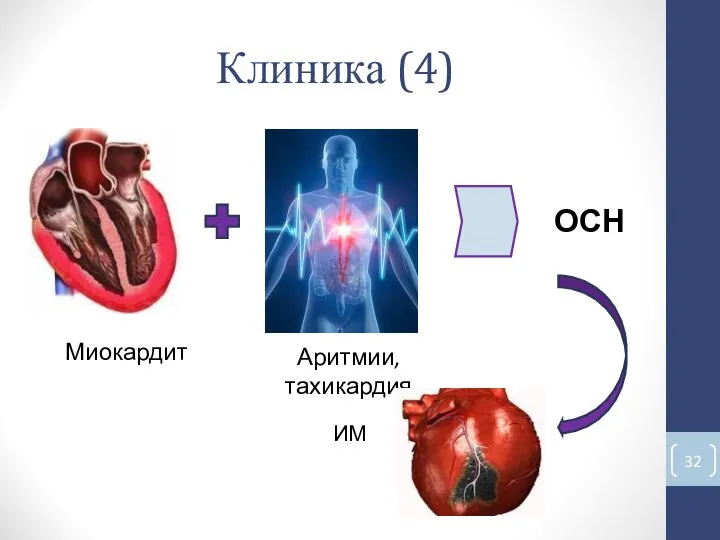 Клиника (4) ИМ Миокардит Аритмии, тахикардия ОСН