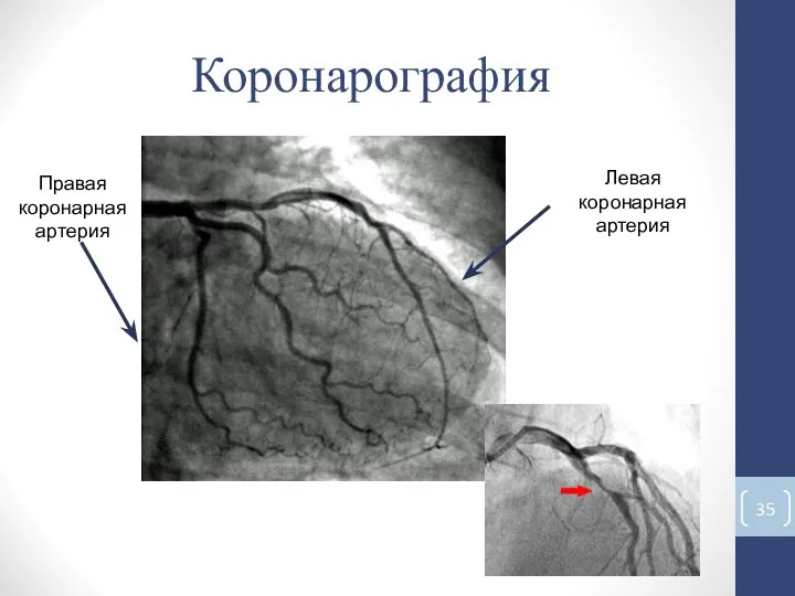 Коронарография Левая коронарная артерия Правая коронарная артерия